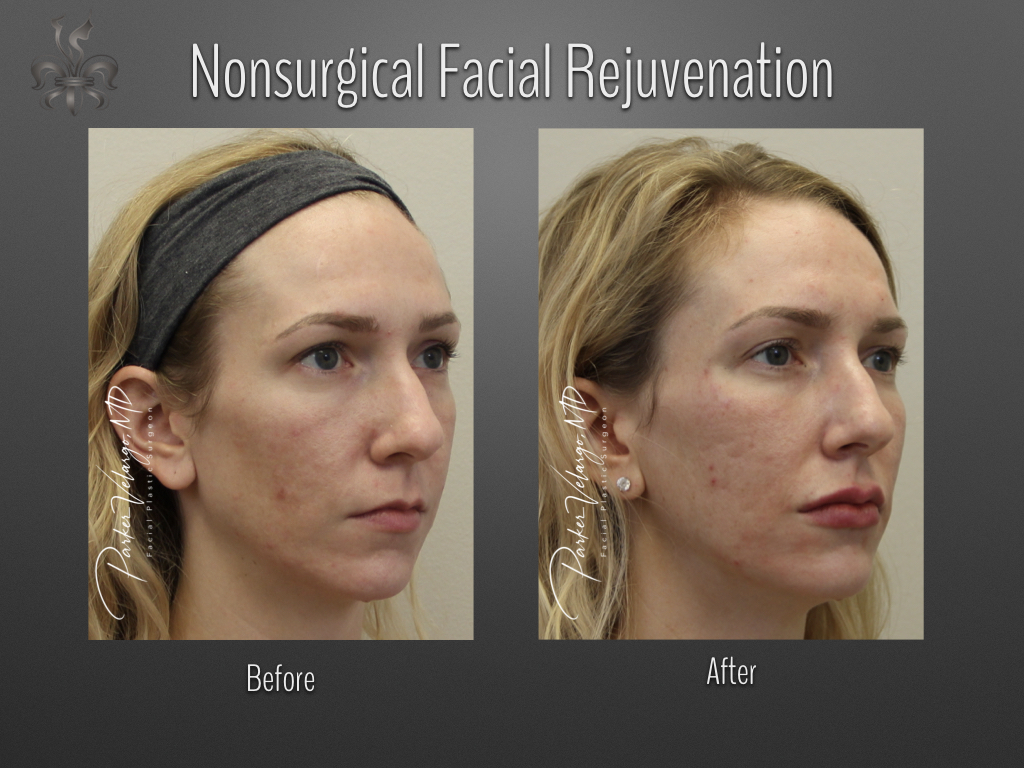 non-surgical facelift before and after