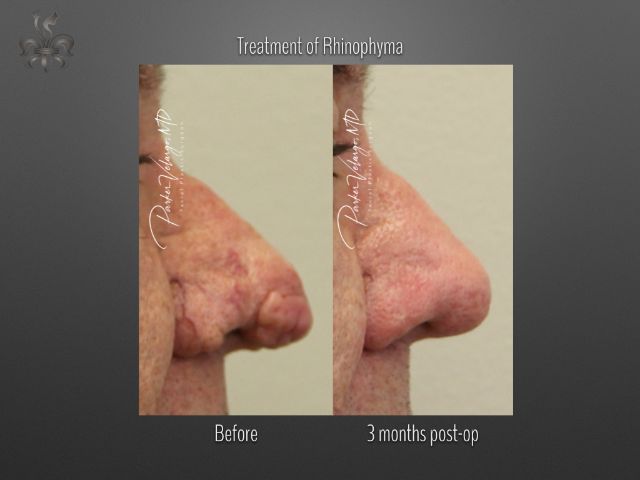 rhinophyma before and after