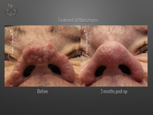 rhinophyma before and after