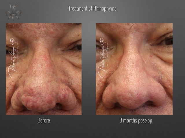 rhinophyma before and after