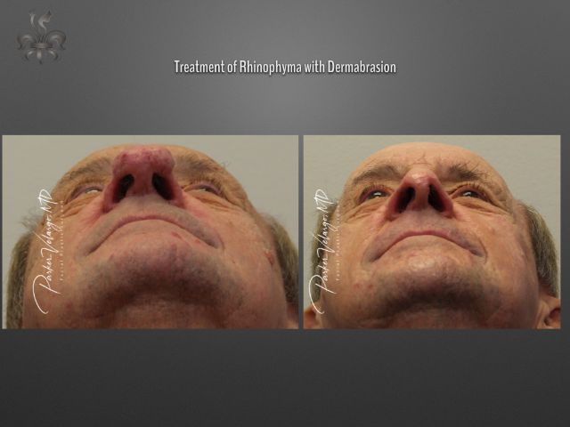 rhinophyma before and after