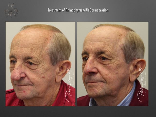 rhinophyma before and after