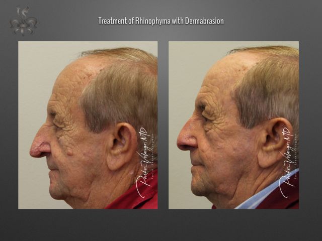 rhinophyma before and after