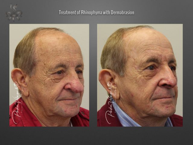 rhinophyma before and after