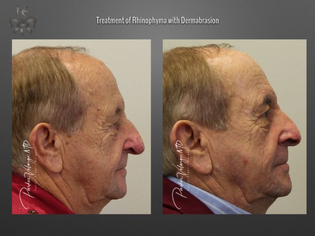 rhinophyma before and after