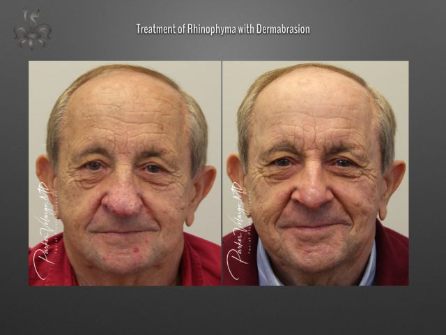 rhinophyma before and after