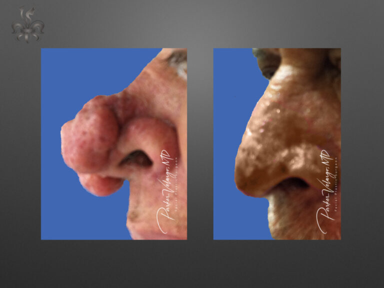 rhinophyma before & after