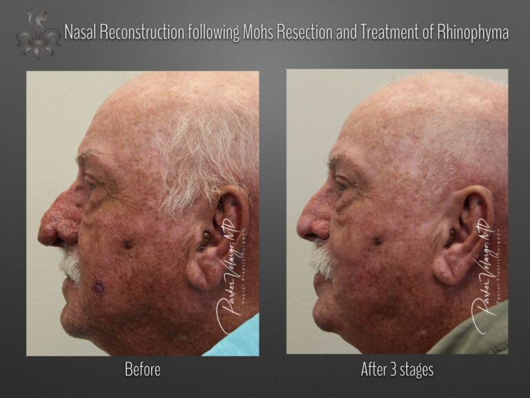 rhinophyma before & after