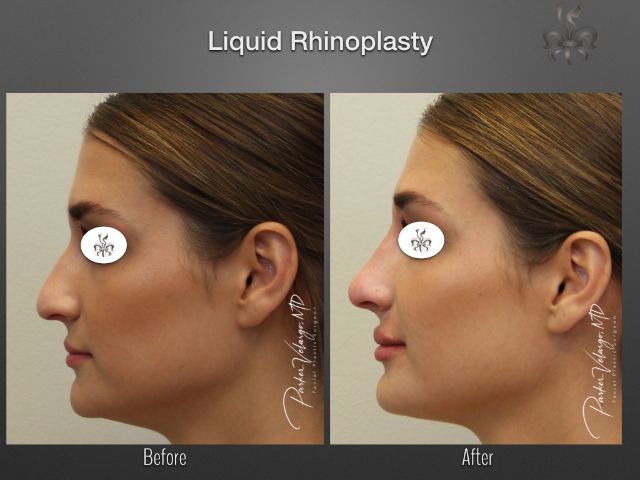 rhinoplasty before and after