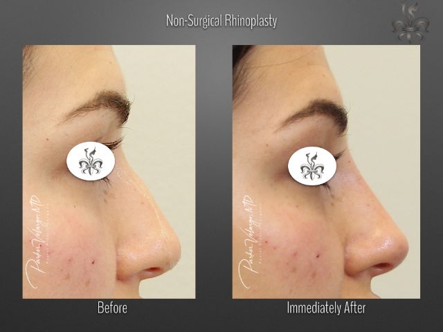 rhinoplasty before and after