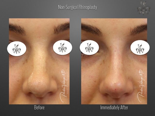 rhinoplasty before and after