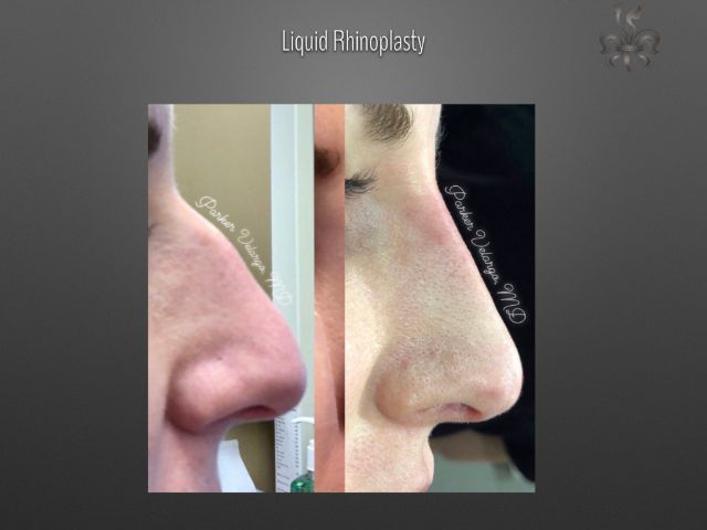 rhinoplasty before and after