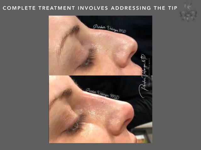 rhinoplasty before and after