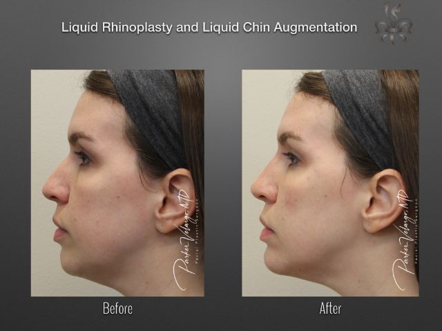 rhinoplasty before and after