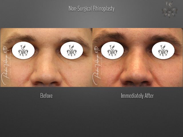 rhinoplasty before and after