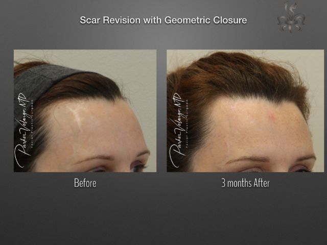 scar revision before and after
