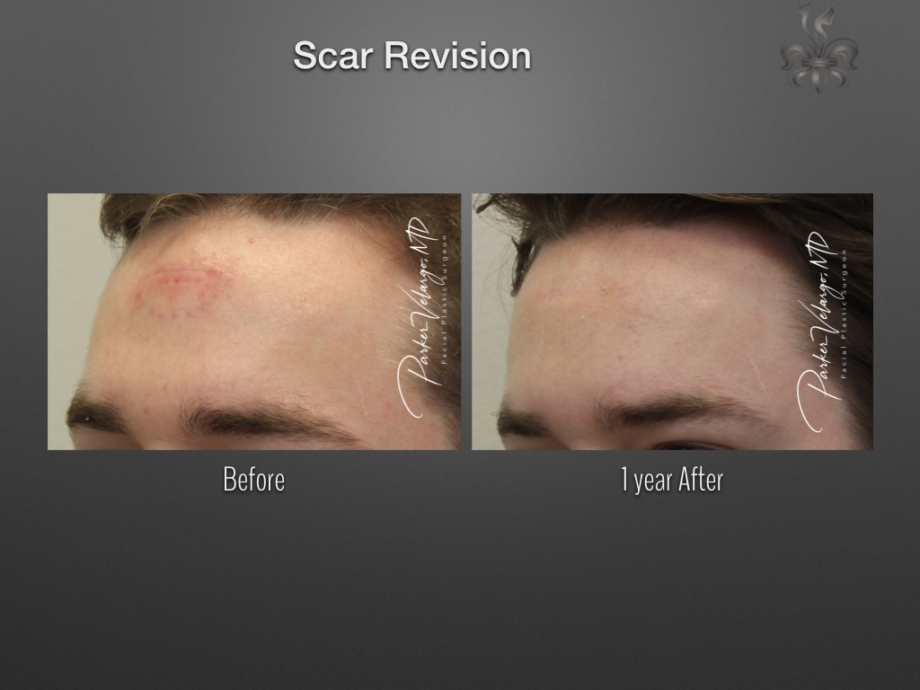skin cancer reconstruction before & after