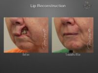 skin cancer reconstruction before and after