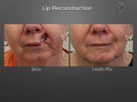 skin cancer reconstruction before and after