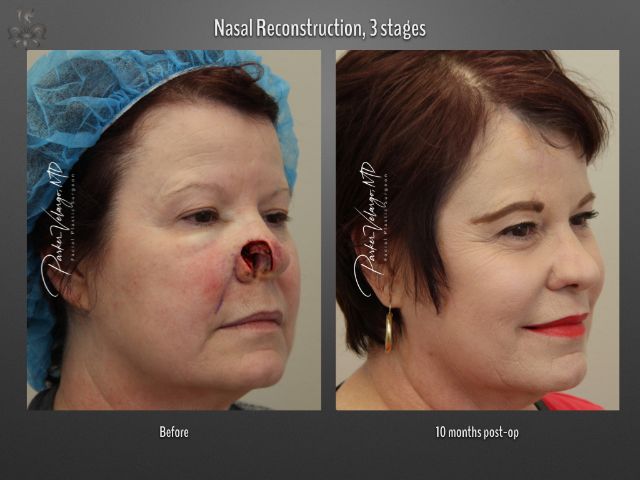 skin cancer reconstruction before and after