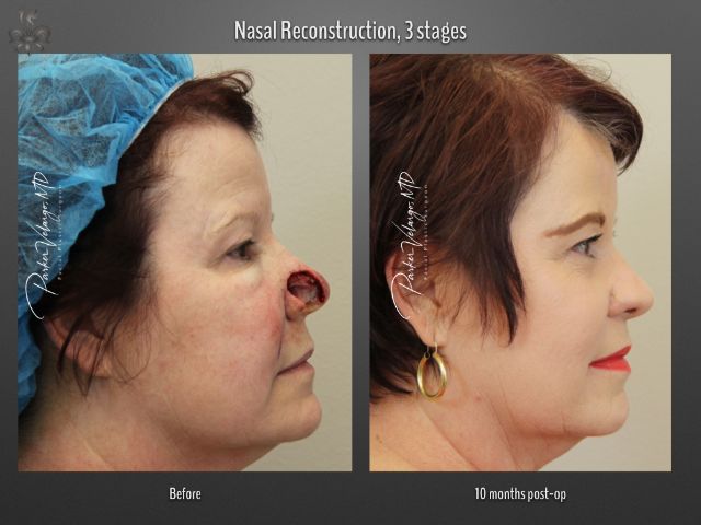 skin cancer reconstruction before and after