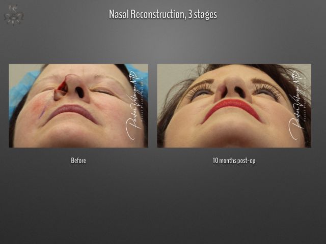 skin cancer reconstruction before and after