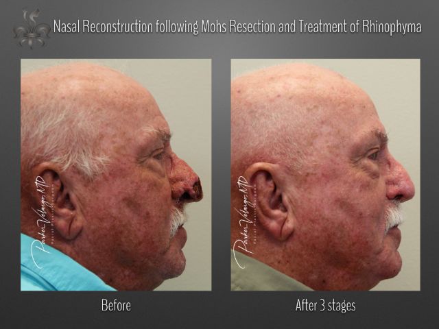 skin cancer reconstruction before and after