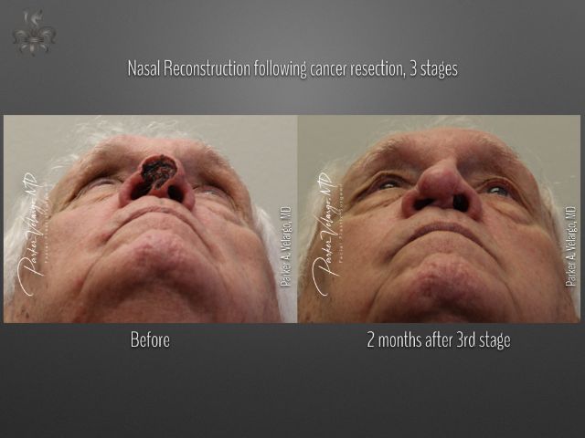 skin cancer reconstruction before and after