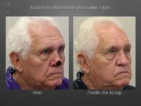 skin cancer reconstruction before and after