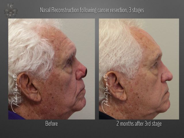 skin cancer reconstruction before and after