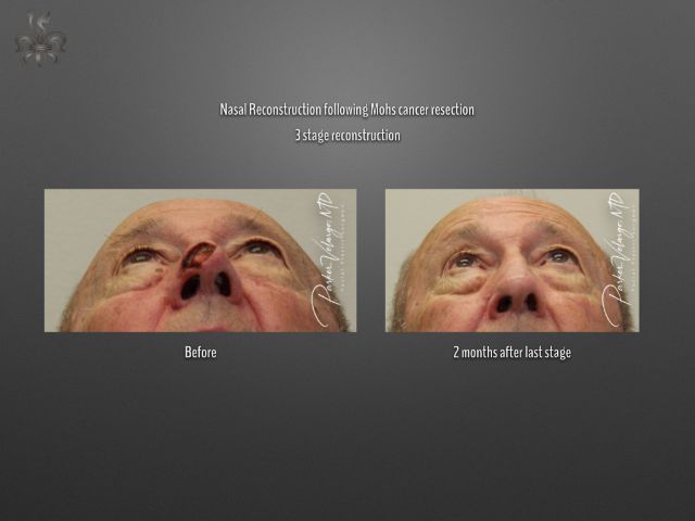 skin cancer reconstruction before and after