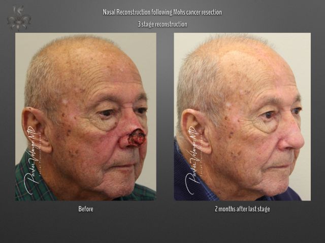 skin cancer reconstruction before and after