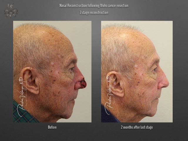 skin cancer reconstruction before and after