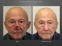 skin cancer reconstruction before and after