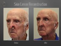skin cancer reconstruction before and after