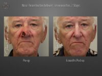 skin cancer reconstruction before and after
