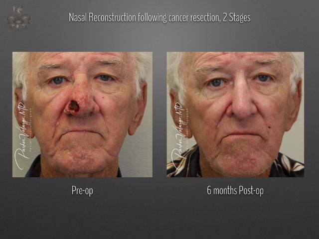 skin cancer reconstruction before and after