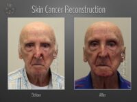 skin cancer reconstruction before and after