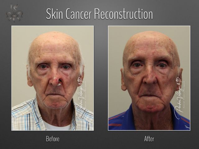 skin cancer reconstruction before and after