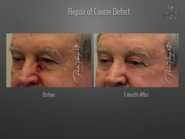 skin cancer reconstruction before and after