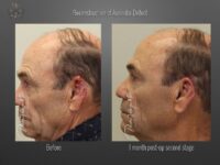skin cancer reconstruction before and after