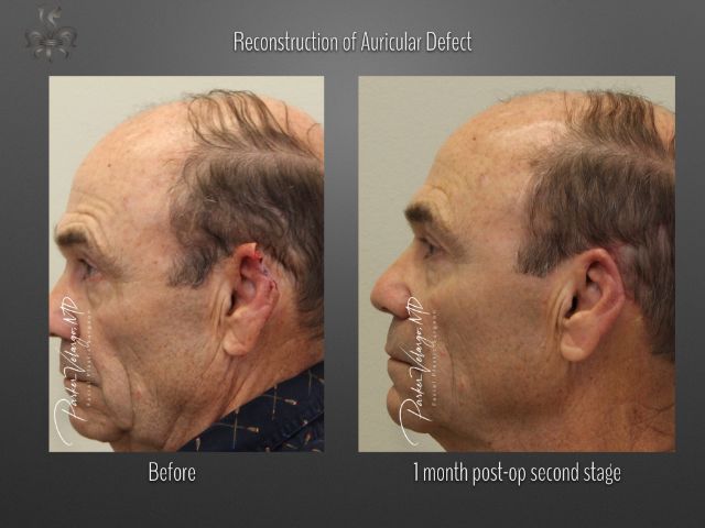 skin cancer reconstruction before and after