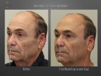 skin cancer reconstruction before and after
