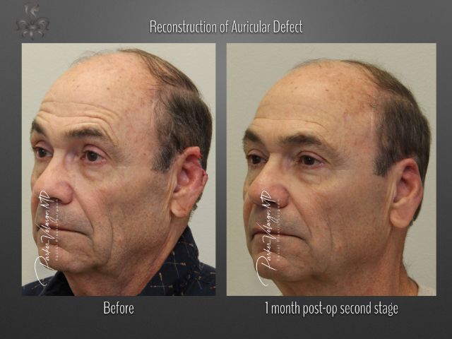 skin cancer reconstruction before and after