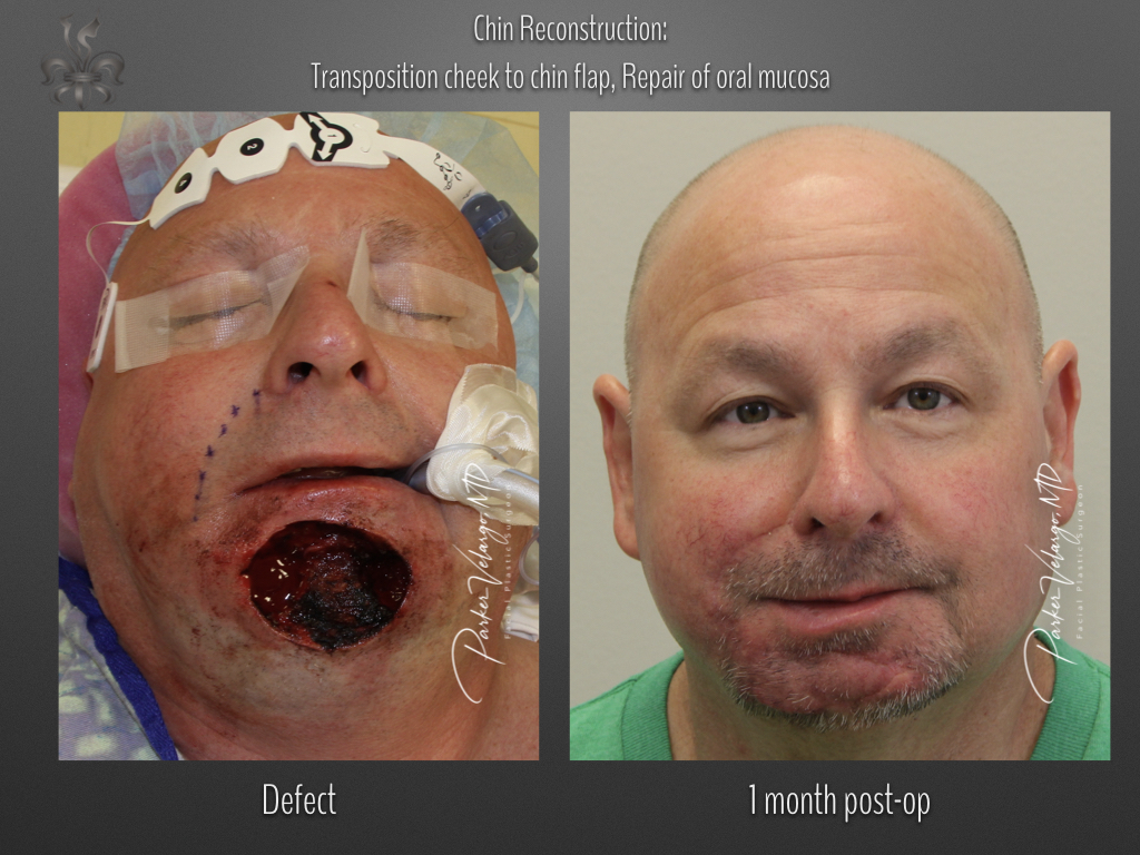 skin cancer reconstruction before & after