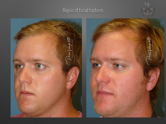 trauma repair before and after