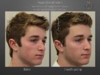 trauma repair before and after