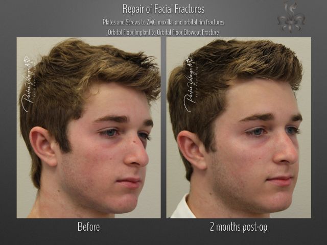 trauma repair before and after