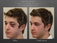 trauma repair before and after