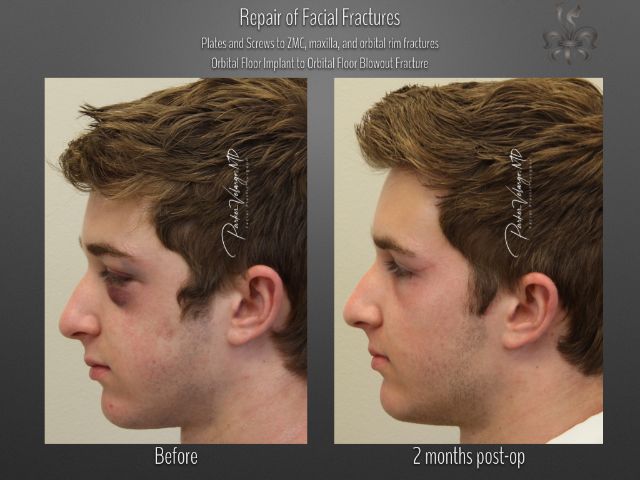 trauma repair before and after